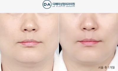 Before & After
