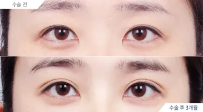 Before & After