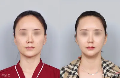 Before & After