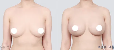Before & After