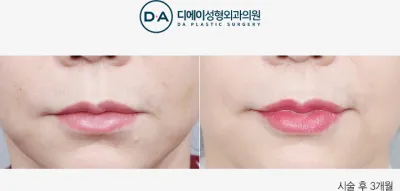 Before & After