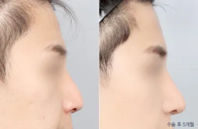 Before & After