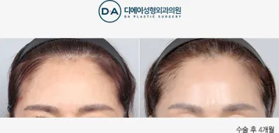 Before & After