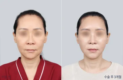 Before & After