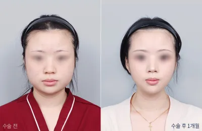Before & After