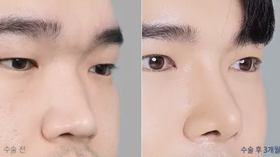 Before & After