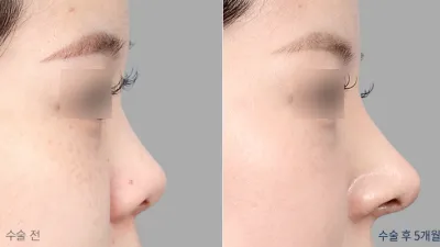 Before & After