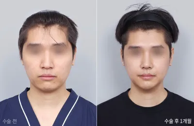 Before & After
