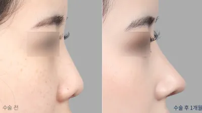 Before & After
