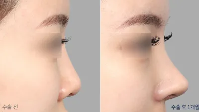 Before & After