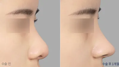Before & After