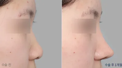 Before & After