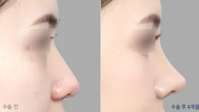 Before & After