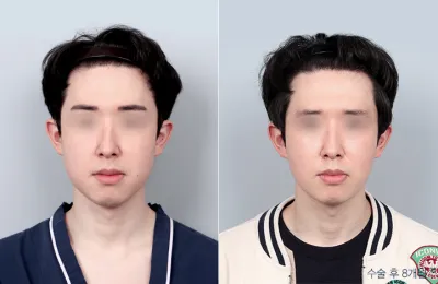 Before & After