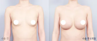Before & After