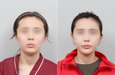 Before & After