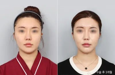 Before & After