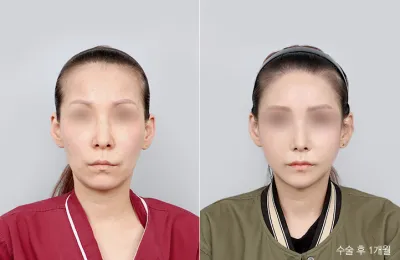 Before & After