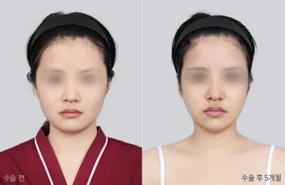 Before & After