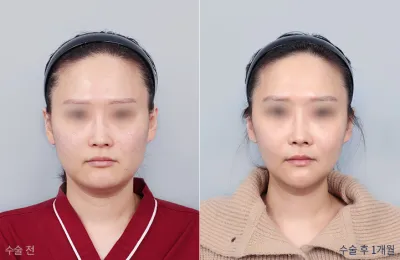 Before & After