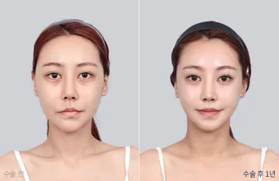 Before & After
