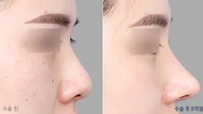 Before & After