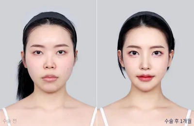 Before & After