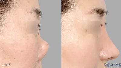 Before & After