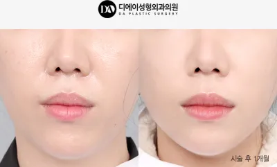 Before & After