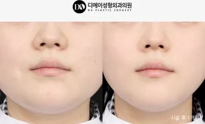 Before & After