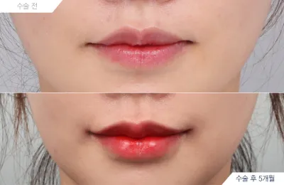 Before & After