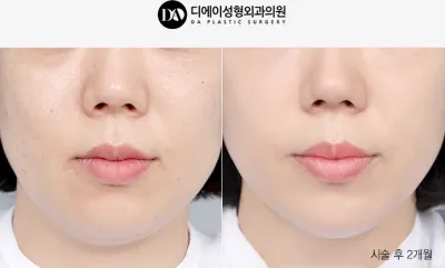 Before & After