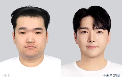 Before & After