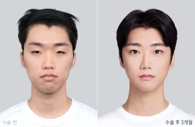 Before & After