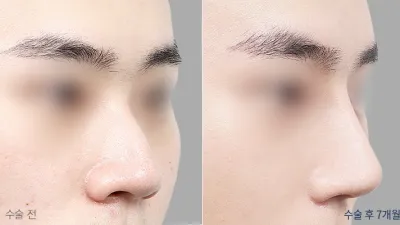 Before & After