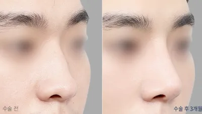 Before & After
