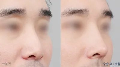 Before & After