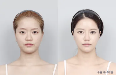 Before & After