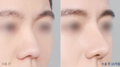Before & After