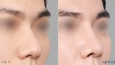 Before & After