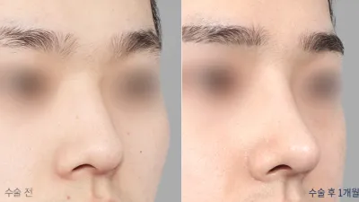 Before & After