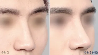 Before & After