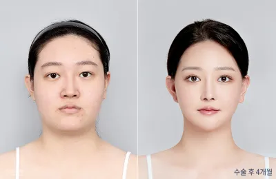 Before & After