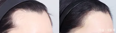 Before & After