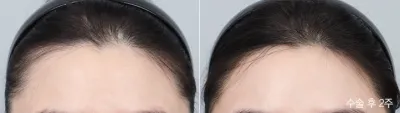 Before & After