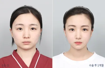 Before & After