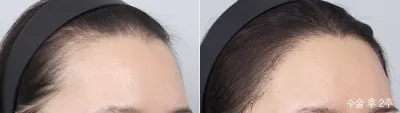 Before & After