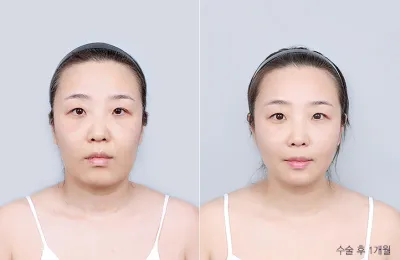 Before & After