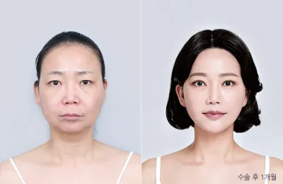 Before & After