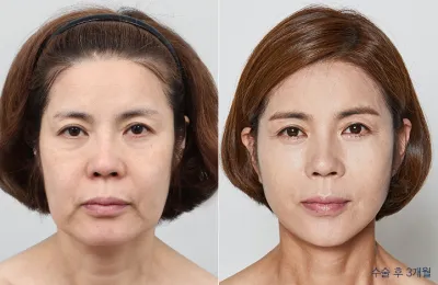 Before & After